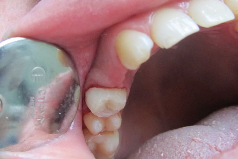 Адгезивные протезы до