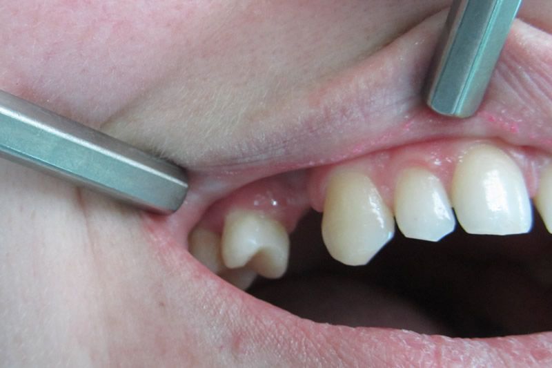 Трансформация зубов до