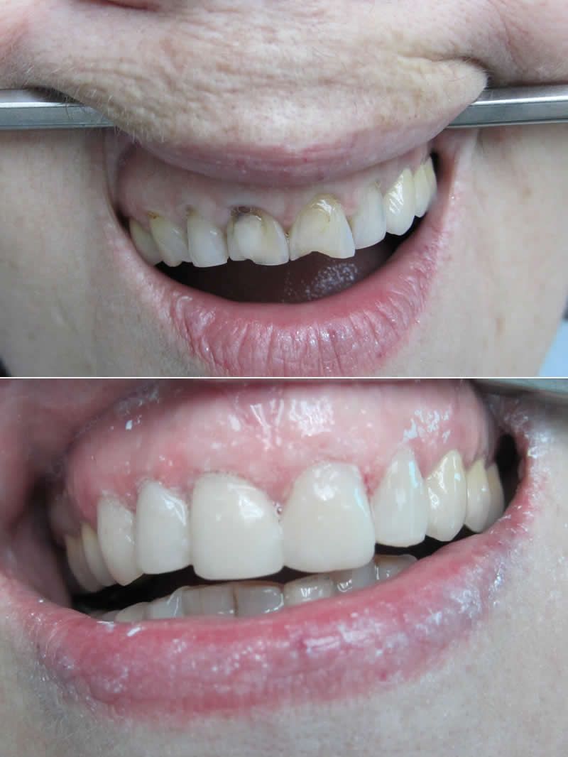 ХУДОЖЕСТВЕННАЯ РЕСТАВРАЦИЯ ЗУБОВ