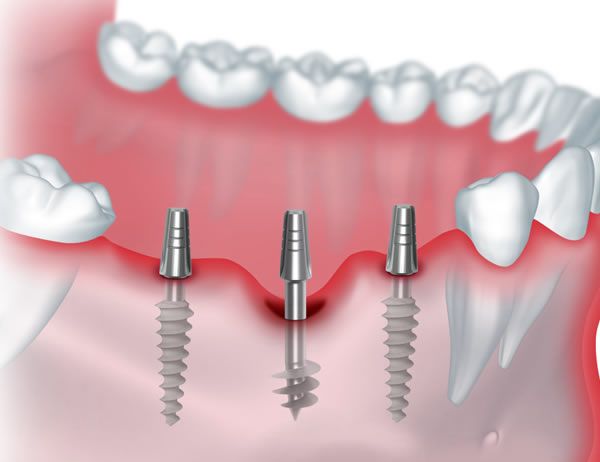 Имплантация