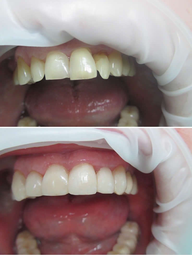 ХУДОЖЕСТВЕННАЯ РЕСТАВРАЦИЯ ЗУБОВ