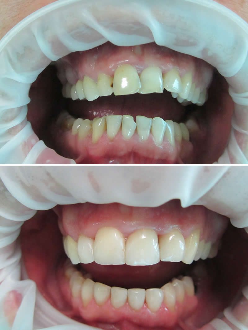 ХУДОЖЕСТВЕННАЯ РЕСТАВРАЦИЯ ЗУБОВ